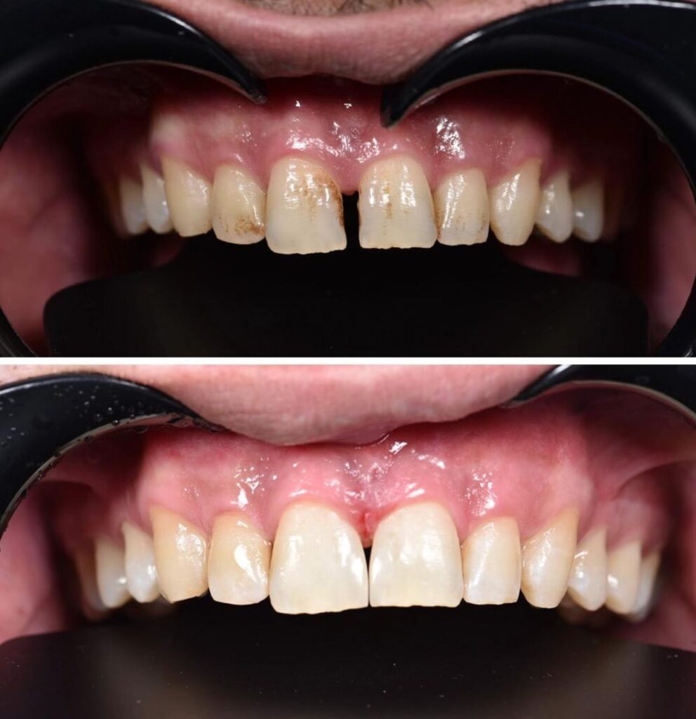 White composite filling treatment in Twickenham for natural tooth repair