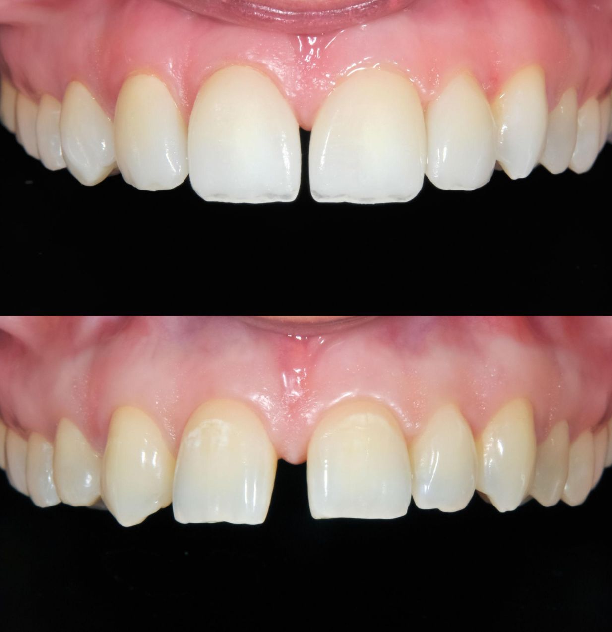 Before and after cosmetic dentistry smile transformation in Twickenham