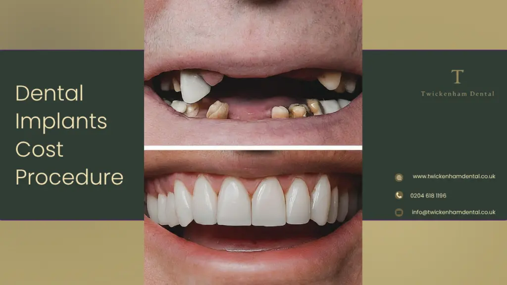 Dental Implants in Twickenham – Costs, Procedure and Tooth Replacement Treatment Options