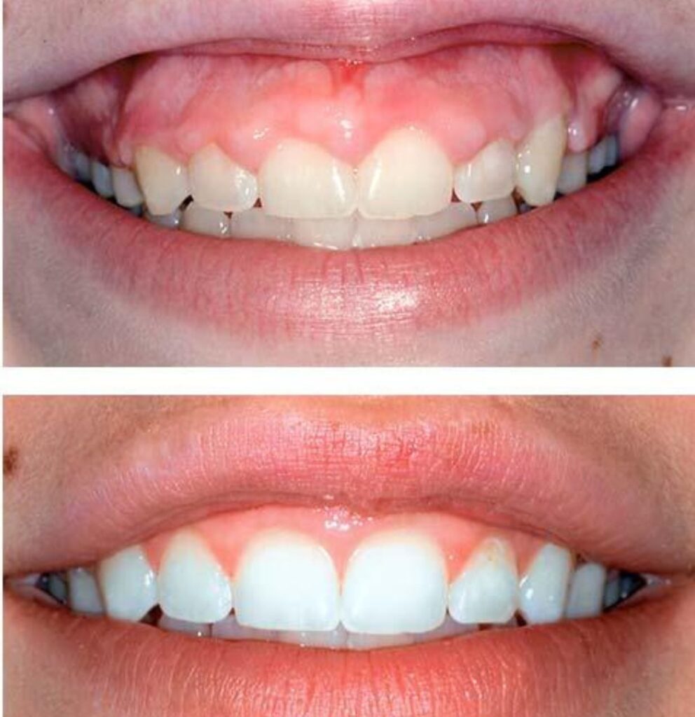 Before and after gum line correction treatment in Twickenham