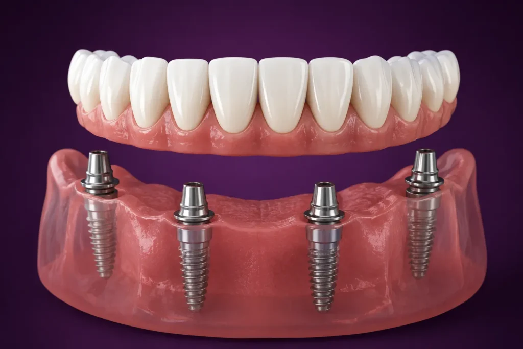 All-on-4 dental implants treatment in Twickenham for full smile restoration