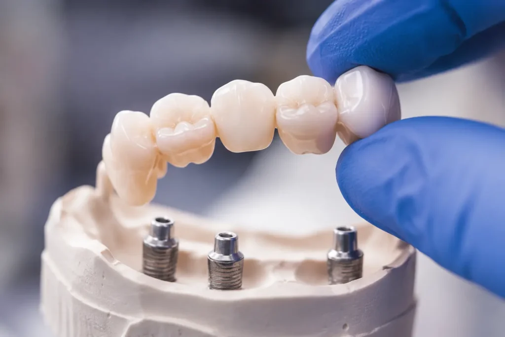 Restorative dental prosthetics and implant-supported teeth solutions